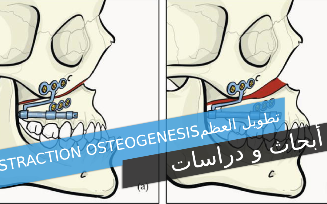 تطويل العظم Distraction Osteogenesis